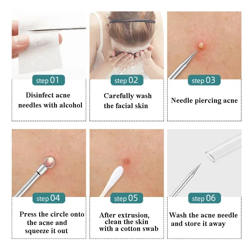 Ultra-Fine No. 5 German Cell Pimples Blackhead Clip